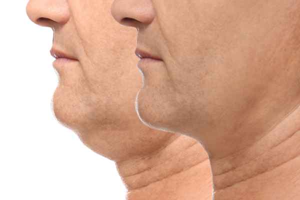 HIFU - Breakthrough in Anti - ageing 2 hifu results Wales