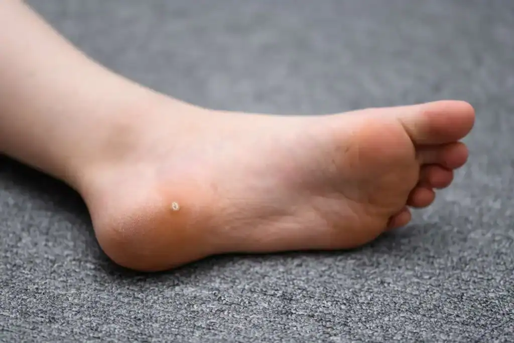 Cryotherapy For Warts And Also Verrucas 2 Image of verruca on the bottom of the foot that able to be treated with Cryotherapy Wales