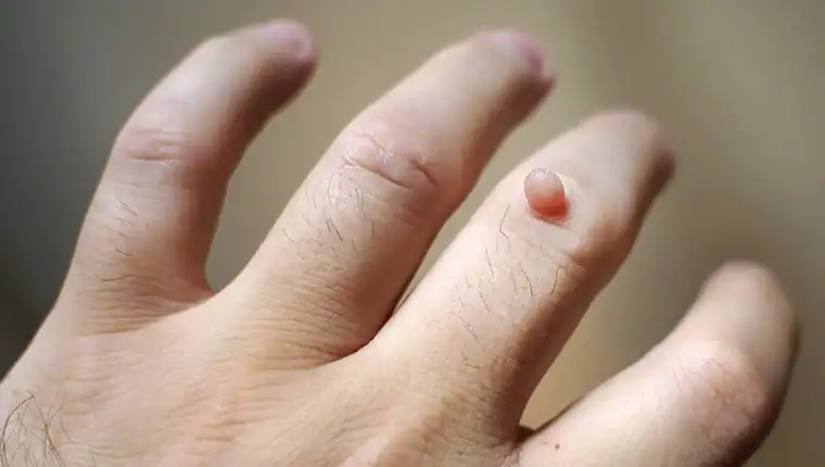 Image of blemish that Cryotherapy Wales can remove with Lipo 360.