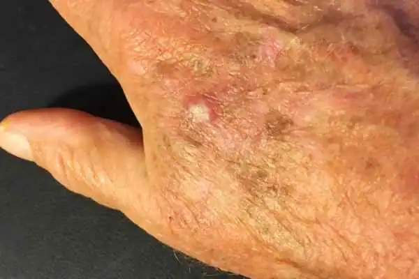 Cryopen For Actinic Keratoses 1 Image of Actinic keratoses Wales on a person hand