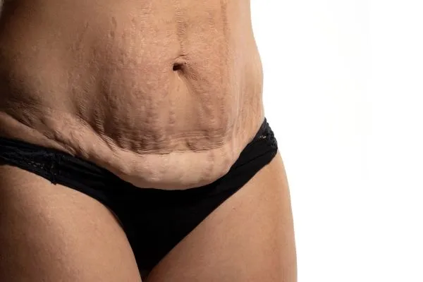 The Science of Skin Tightening 1 The science behind skin tightening Wales picture of a woman's sagging skin on the stomach